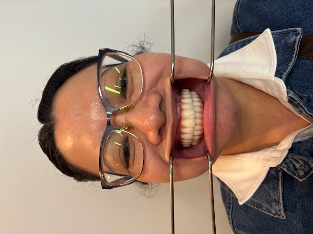 After, Actual $1,999 Implants patient