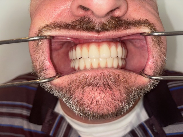 After, Actual $1,999 Implants patient