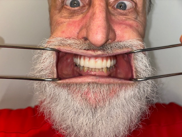 After, Actual $1,999 Implants patient