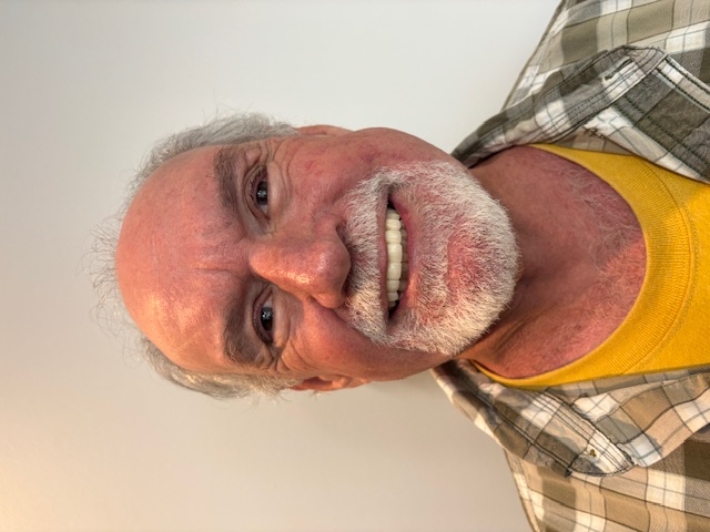 After, Actual $1,999 Implants patient