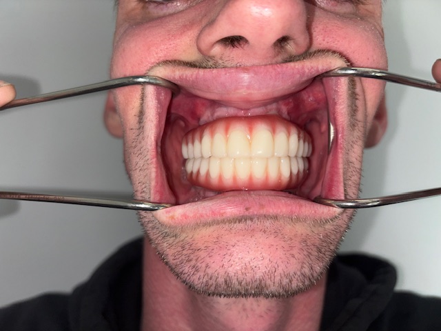 After, Actual $1,999 Implants patient