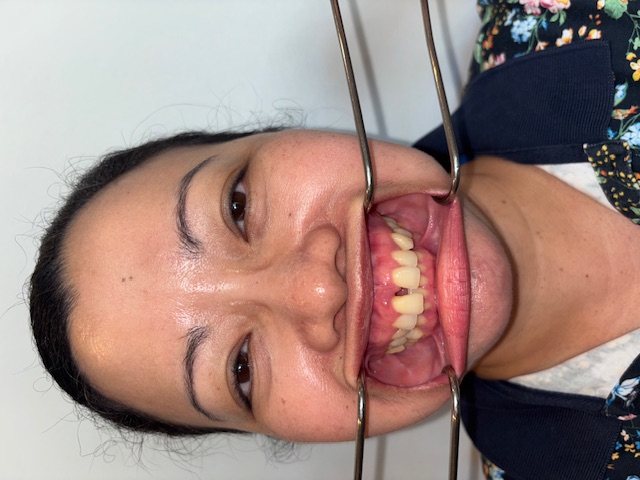 Before, Actual $1,999 Implants patient