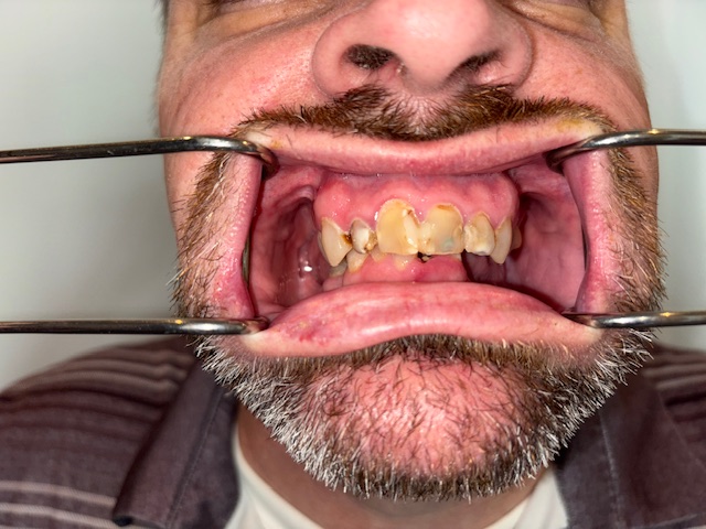 Before, Actual $1,999 Implants patient