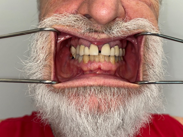 Before, Actual $1,999 Implants patient