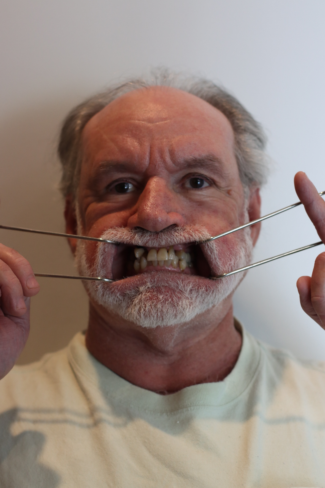 Before, Actual $1,999 Implants patient