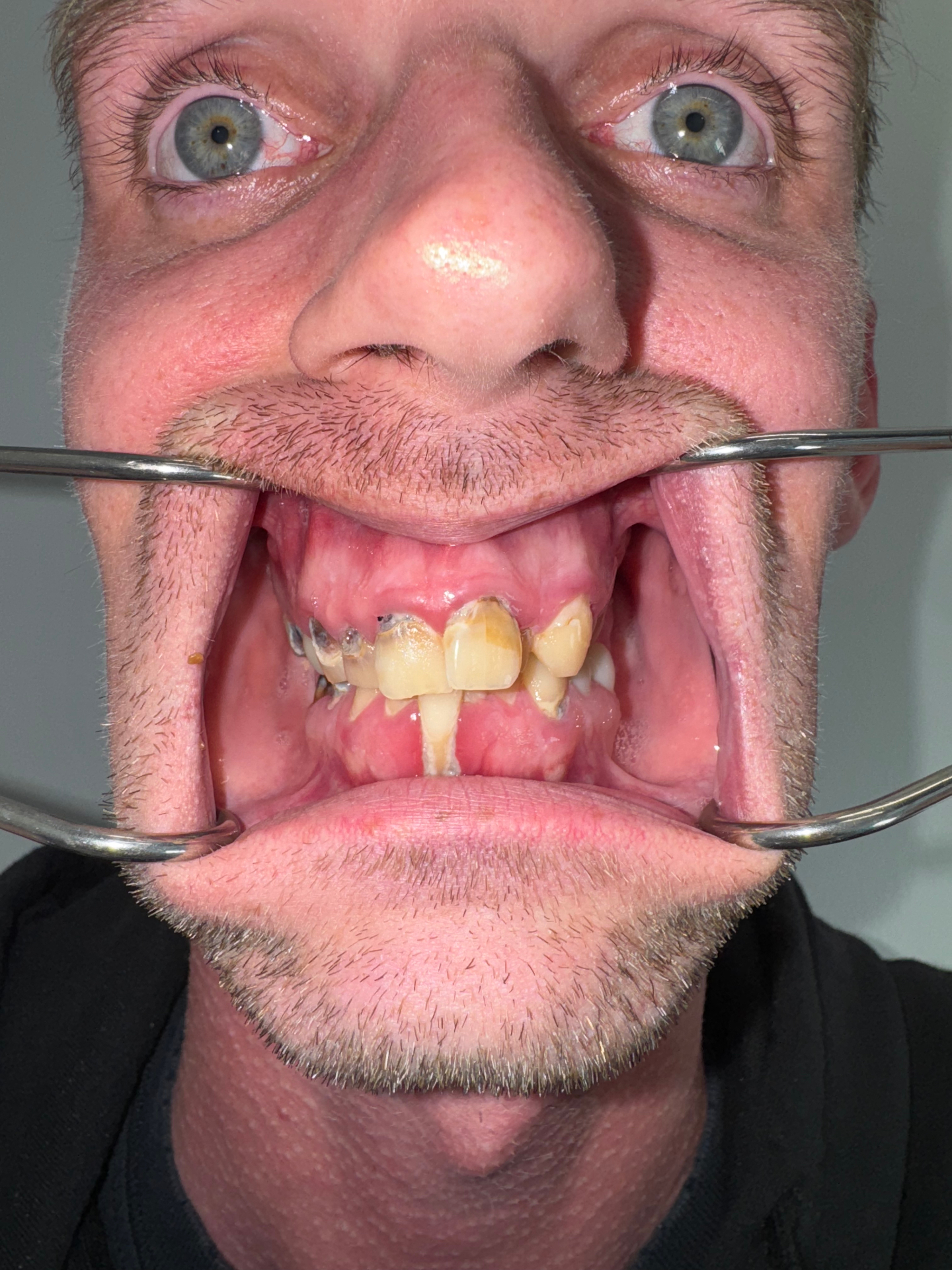 Before, Actual $1,999 Implants patient