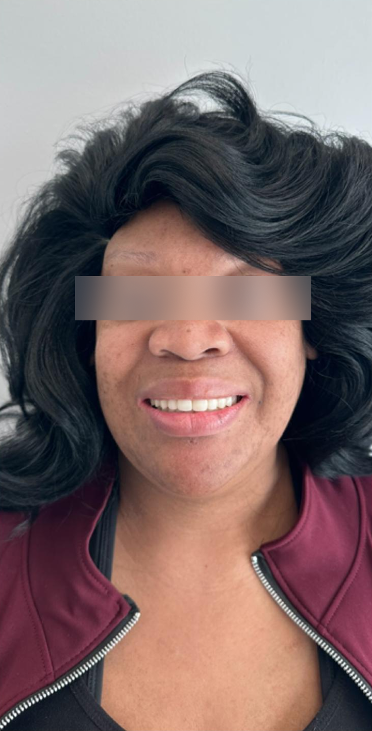 After, Actual $1,999 Implants patient