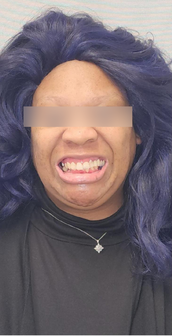 Before, Actual $1,999 Implants patient