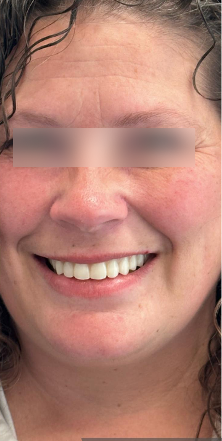 After, Actual $1,999 Implants patient