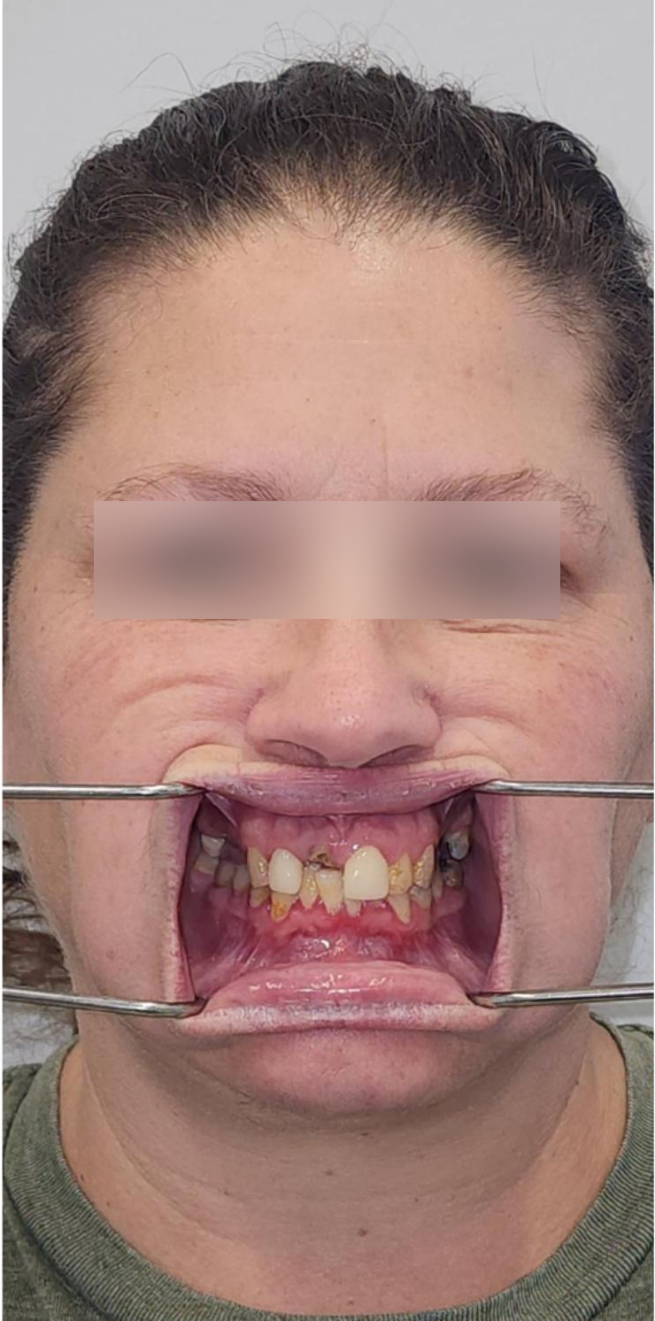 Before, Actual $1,999 Implants patient