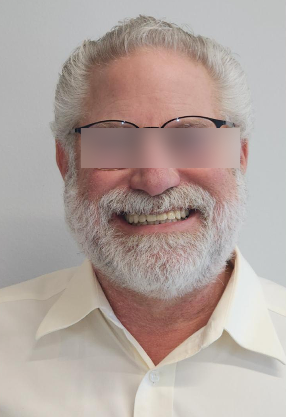 After, Actual $1,999 Implants patient
