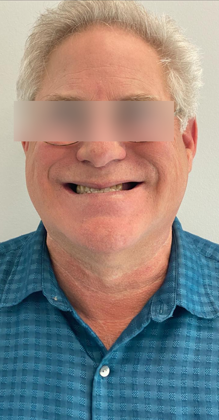 Before, Actual $1,999 Implants patient