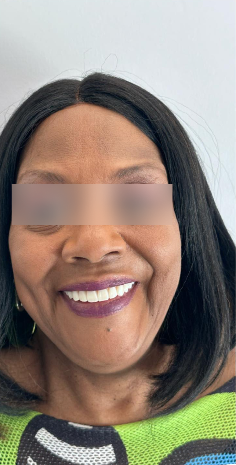 After, Actual $1,999 Implants patient