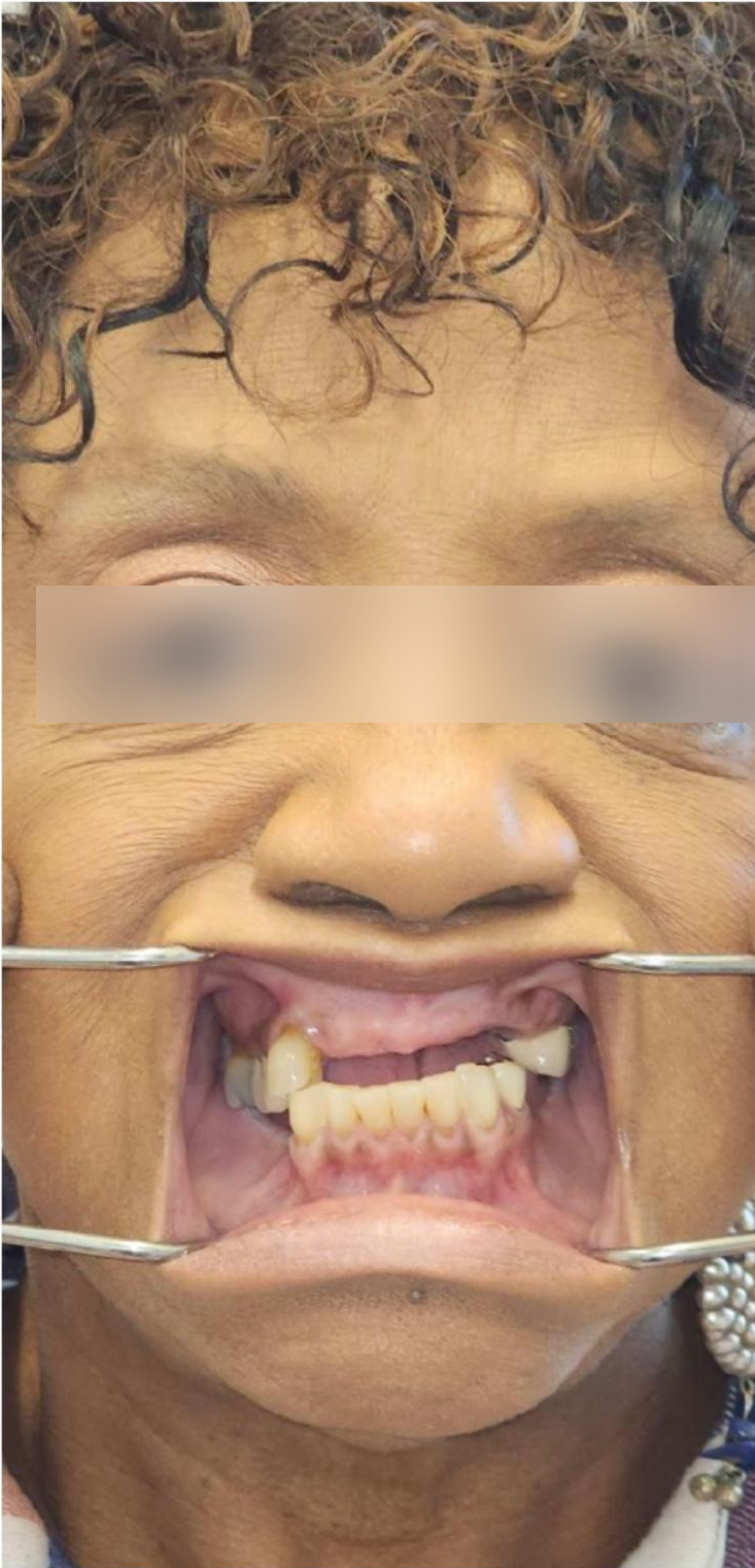 Before, Actual $1,999 Implants patient