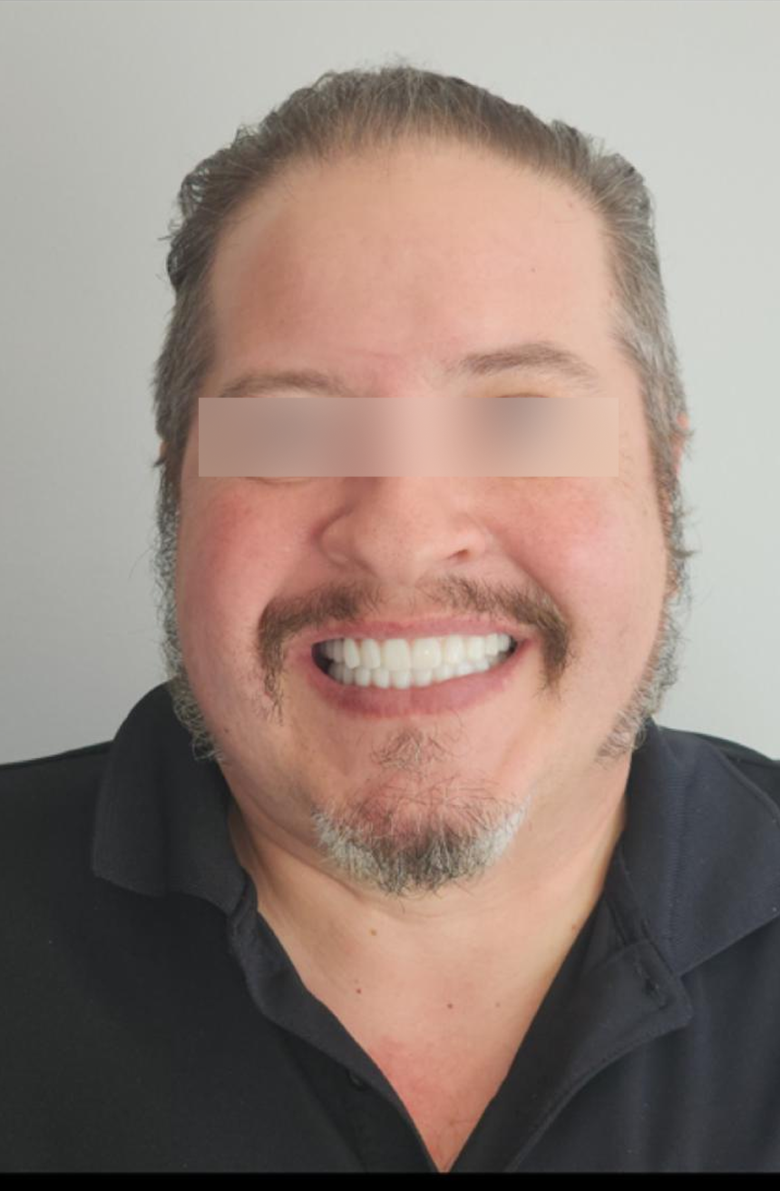 After, Actual $1,999 Implants patient