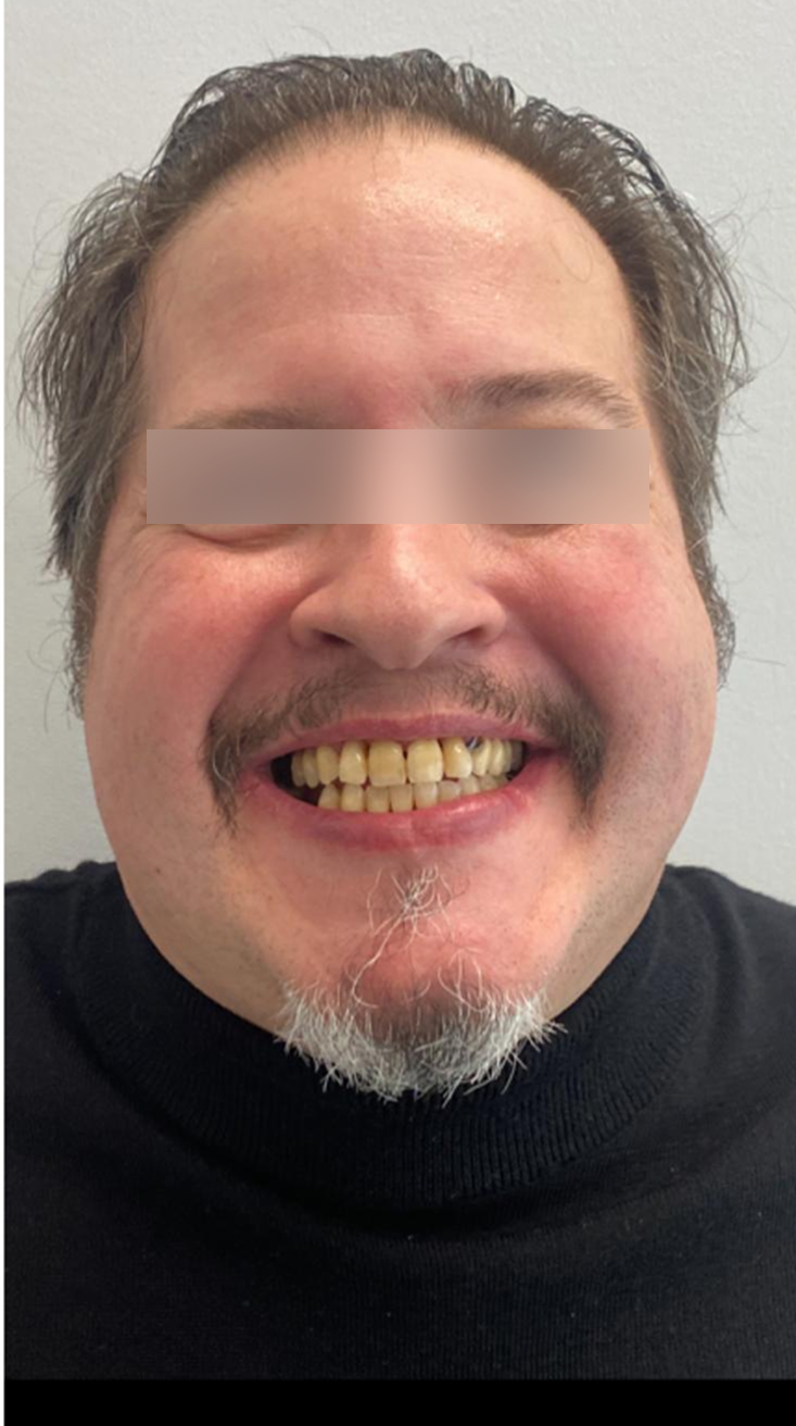 Before, Actual $1,999 Implants patient